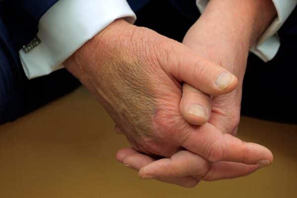 Trump diagnosed with 'chronic venous insufficiency' after swelling: the White House
